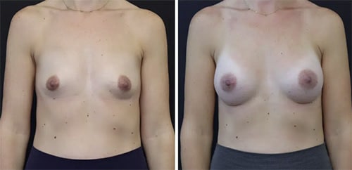 Saline Breast Implant Bay Area