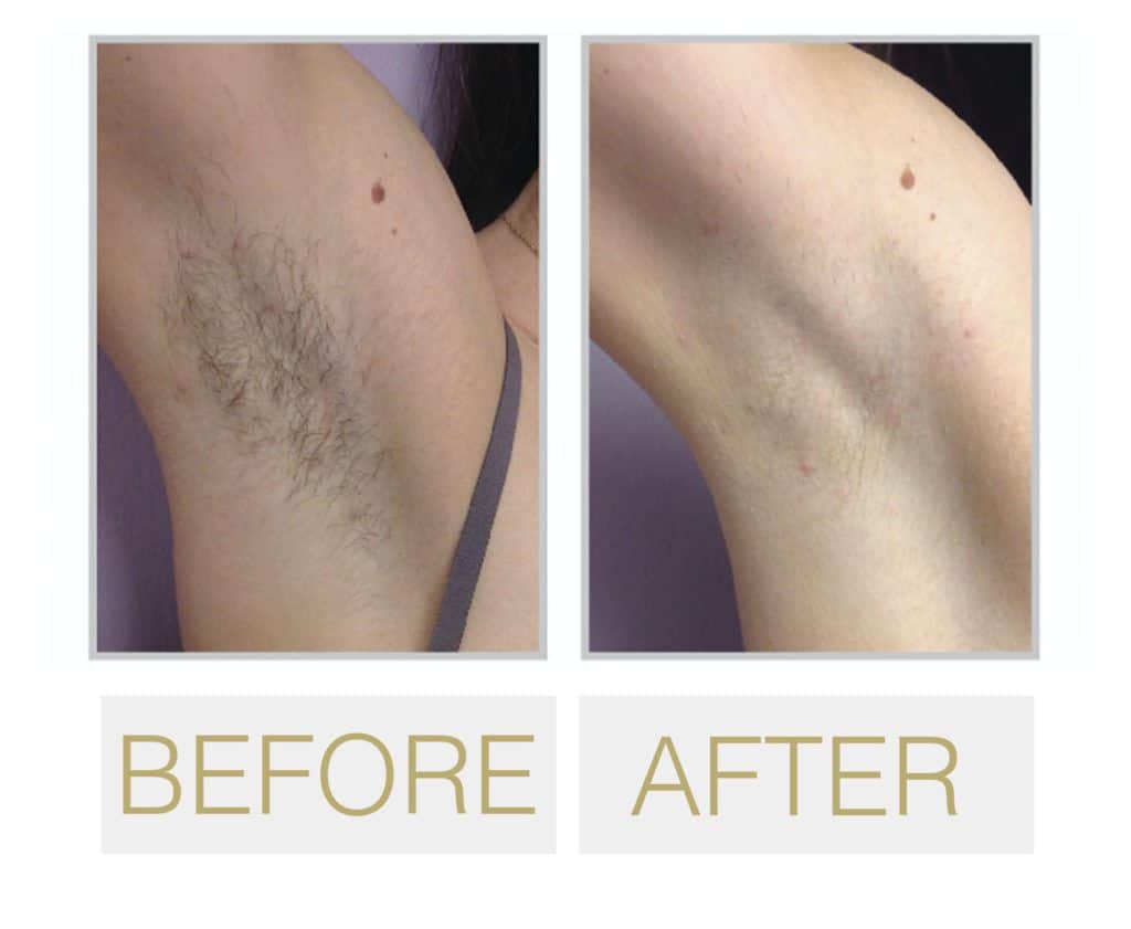 Best San Francisco Laser Hair Removal Doctor Near Me ...