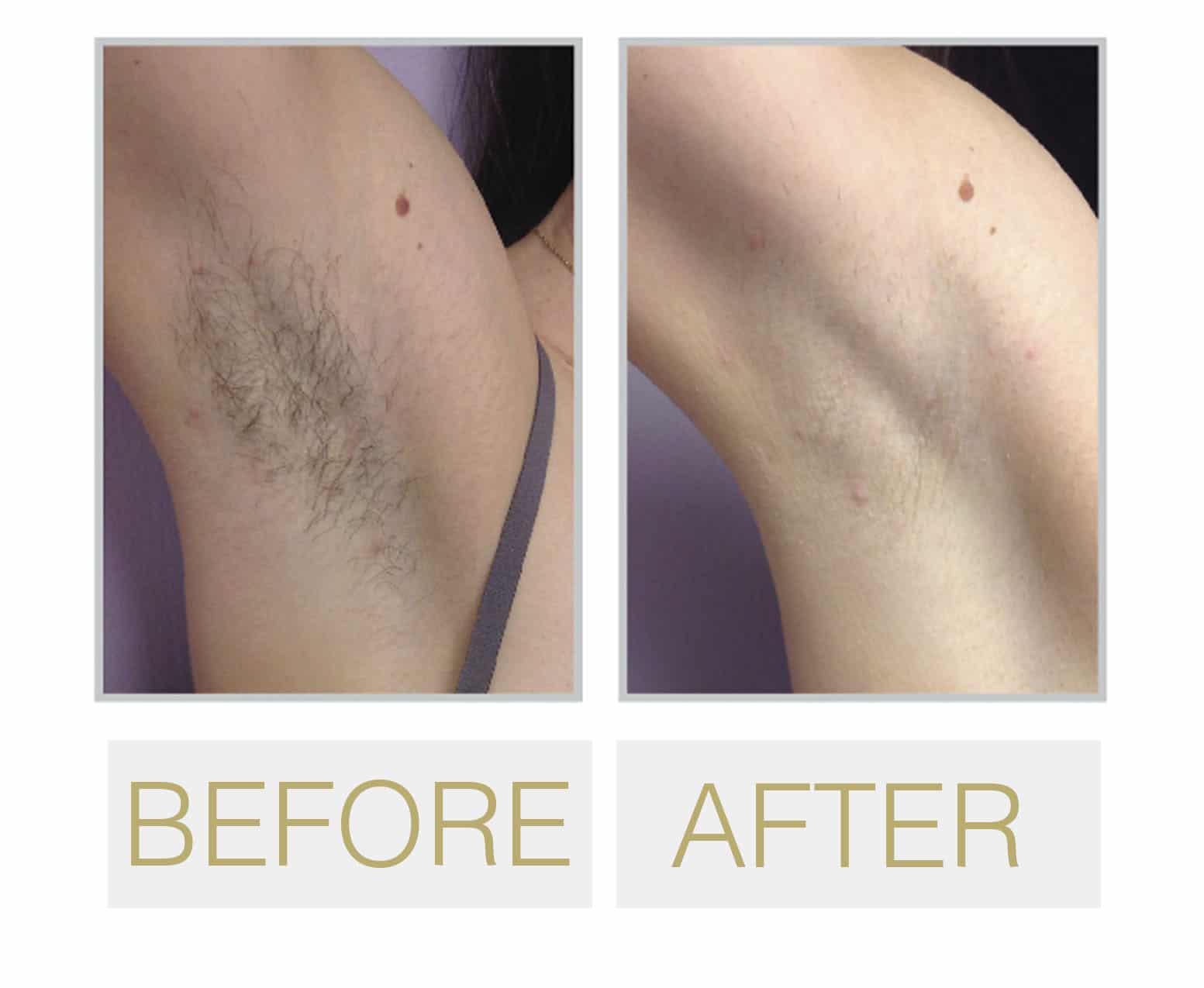 Luxe Laser Hair Removal