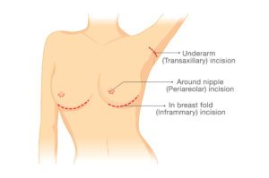 breast augmentation san francisco