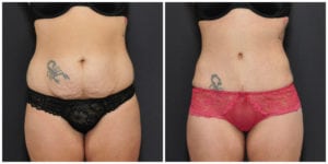 MINI TUMMY TUCK VS FULL TUMMY TUCK