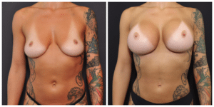 San Francisco Breast Augmentation