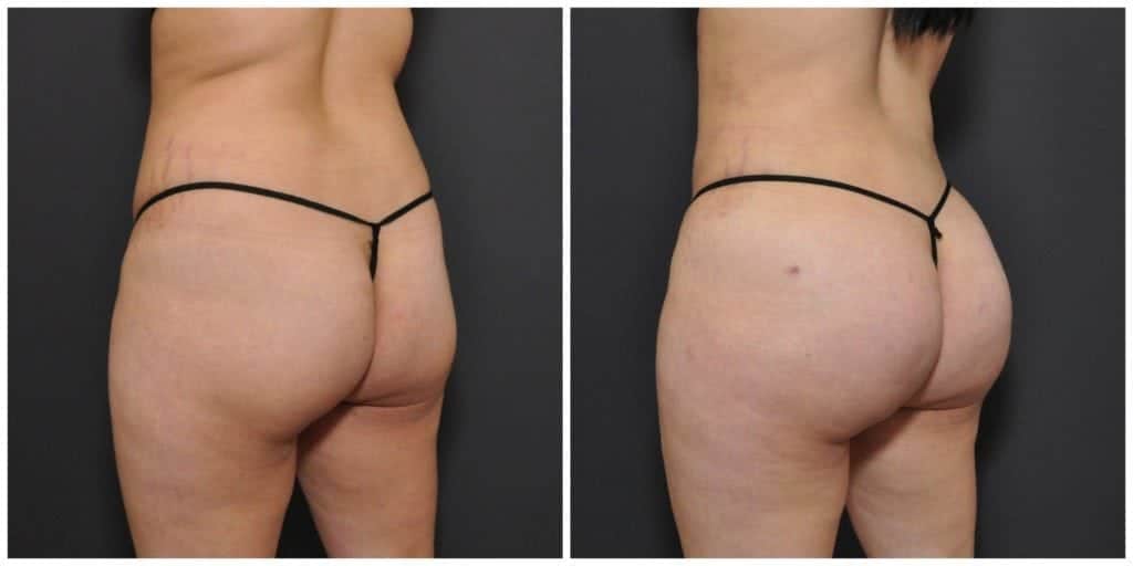 brazilian butt lift san francisco results