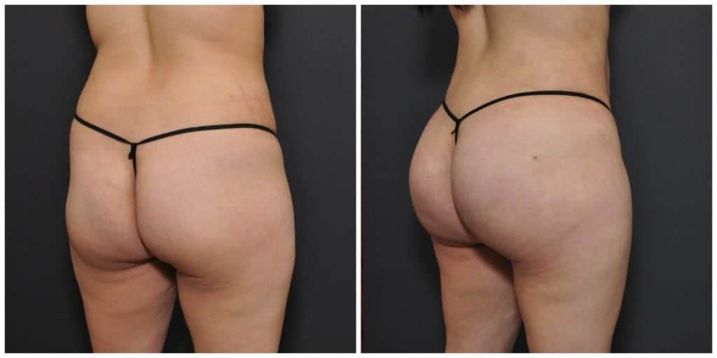 brazilian butt lift san francisco results