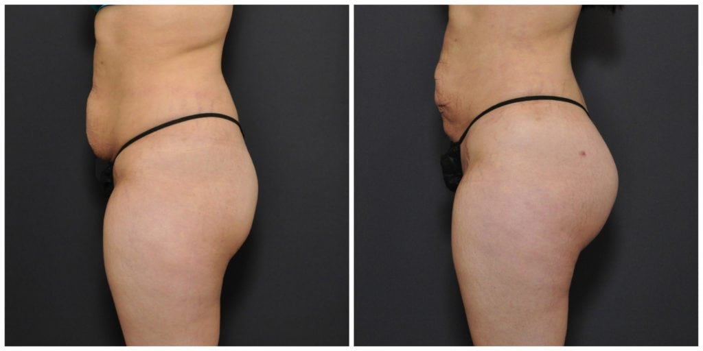 brazilian butt lift san francisco results