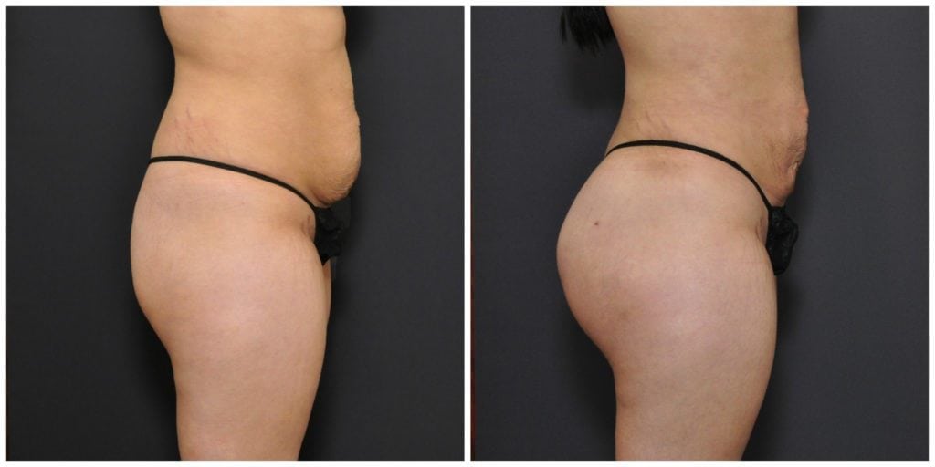 brazilian butt lift san francisco results
