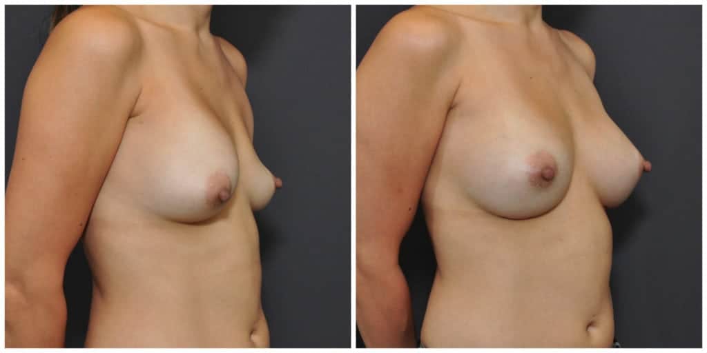 breast implant revision before and after san francisco