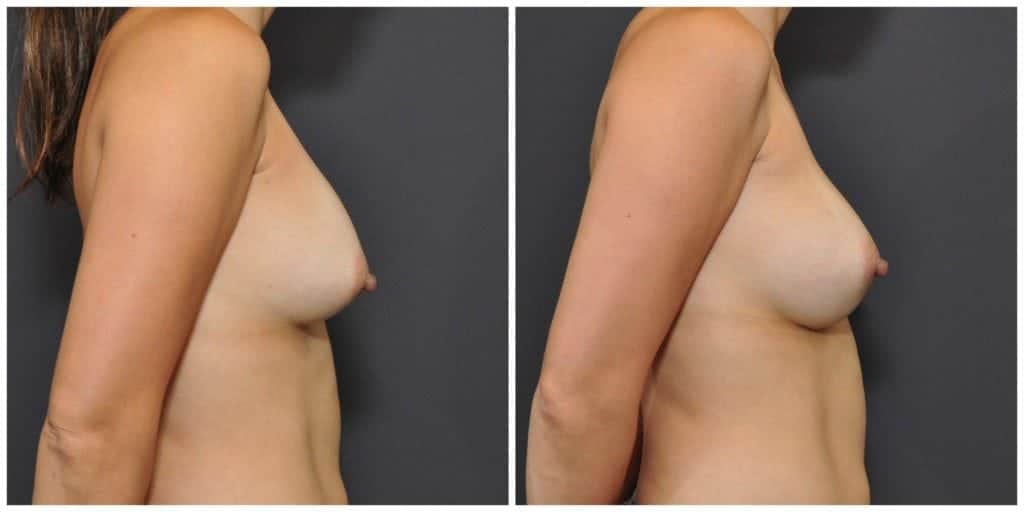 breast augmentation before and after san francisco