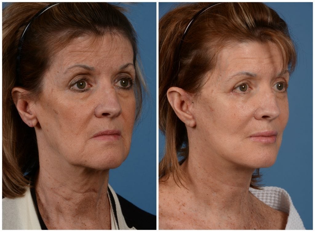 facelift before and after san francisco