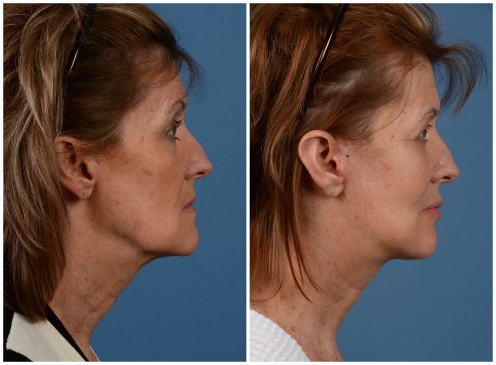 fat grafting bay area results
