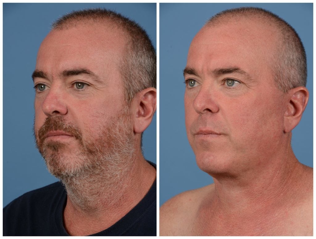 male neck lift san francisco