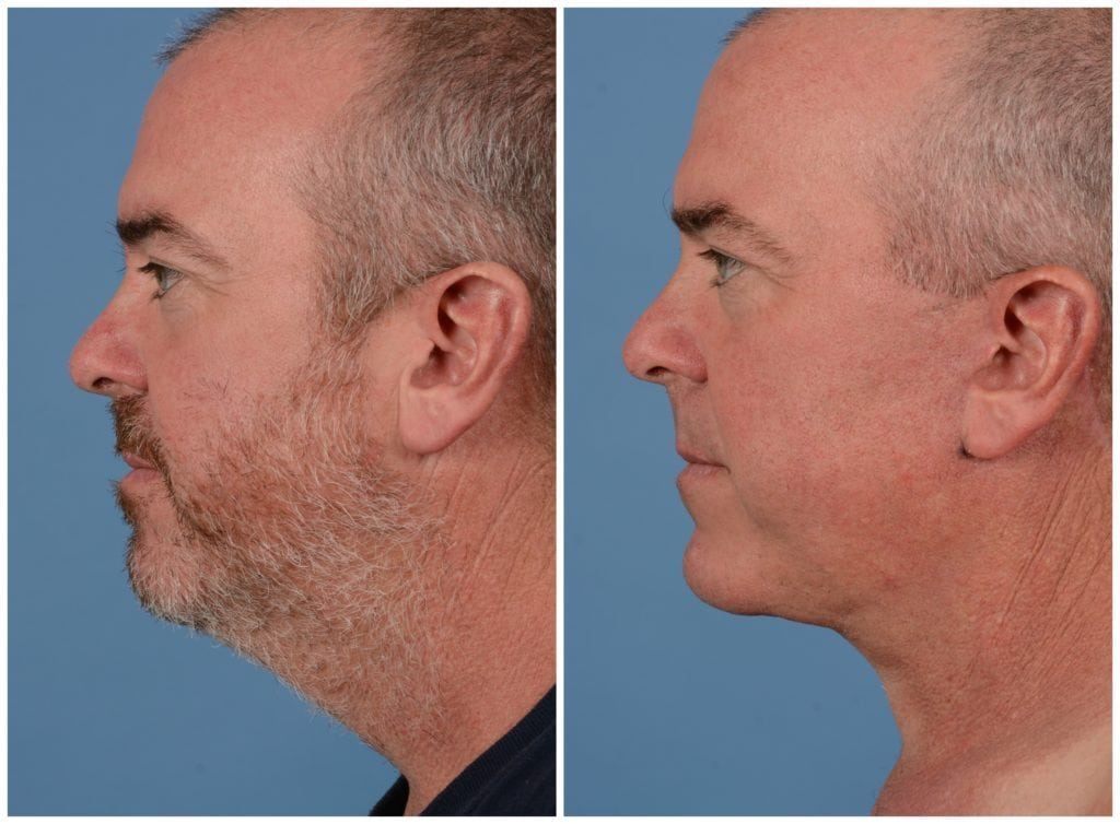 male neck lift san francisco