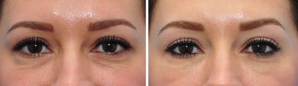 fillers for tear troughs before and after