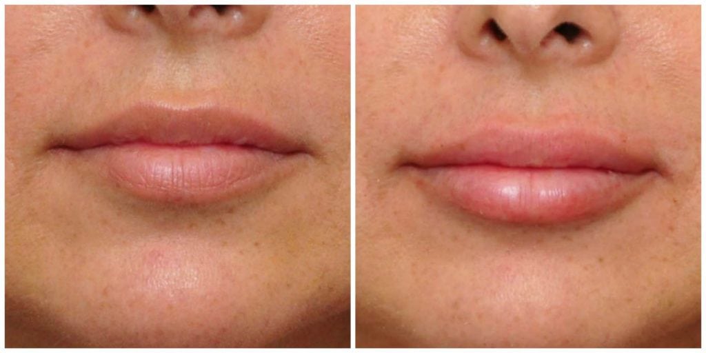 lip filler bay area results