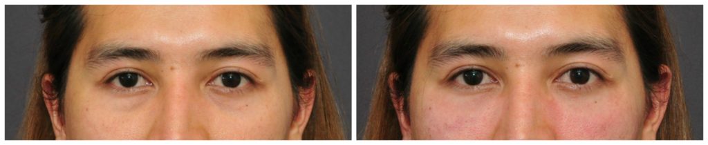 injectables before and after bay area