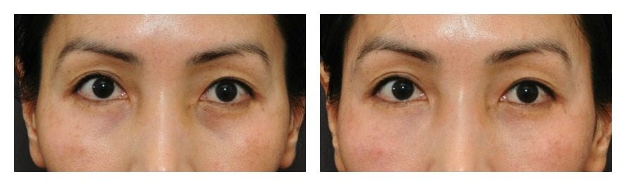 fillers under eyes san francisco