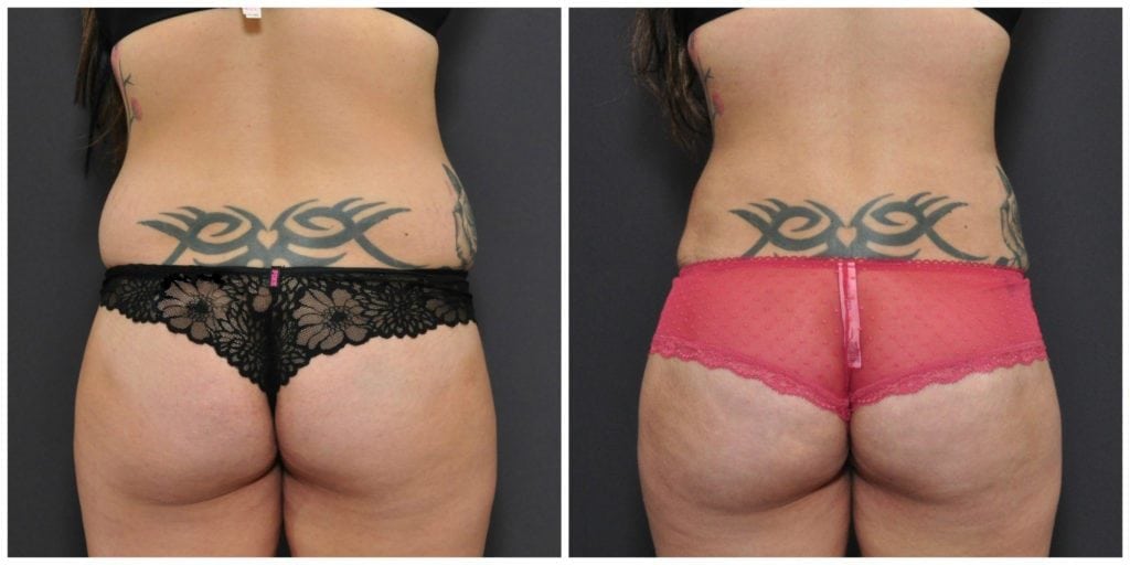 Brazilian Butt Lift Photo San Francisco