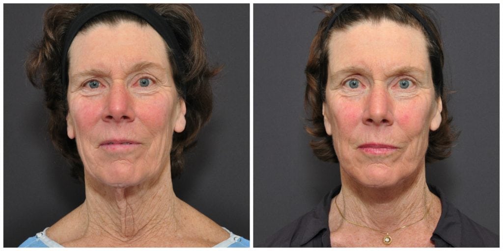 neck lift san francisco before and after