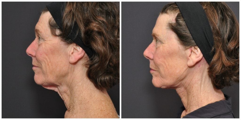 neck lift san francisco before and after