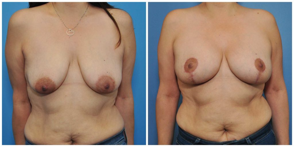 breast augmentation and lift bay area before and after