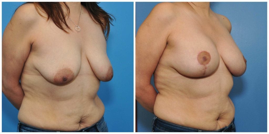 breast augmentation and lift bay area before and after