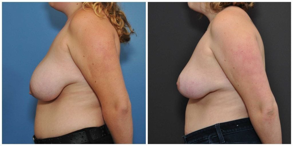 breast reduction before and after bay area