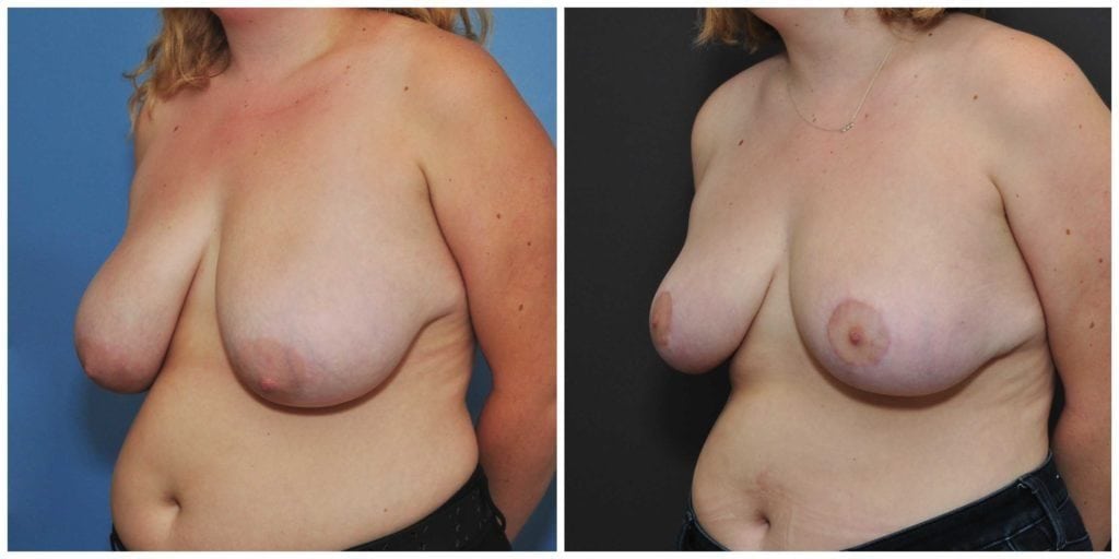 breast reduction before and after bay area