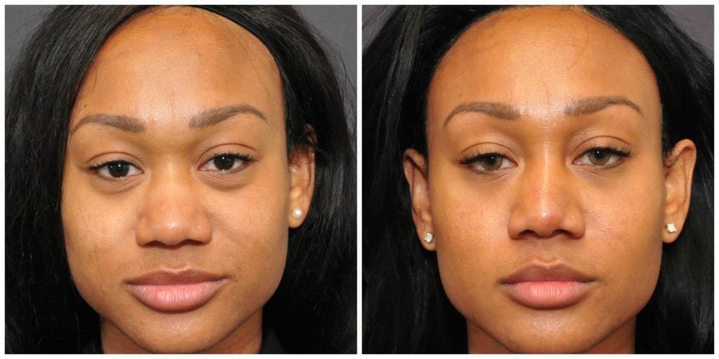 non surgical rhinoplasty before and after san francisco