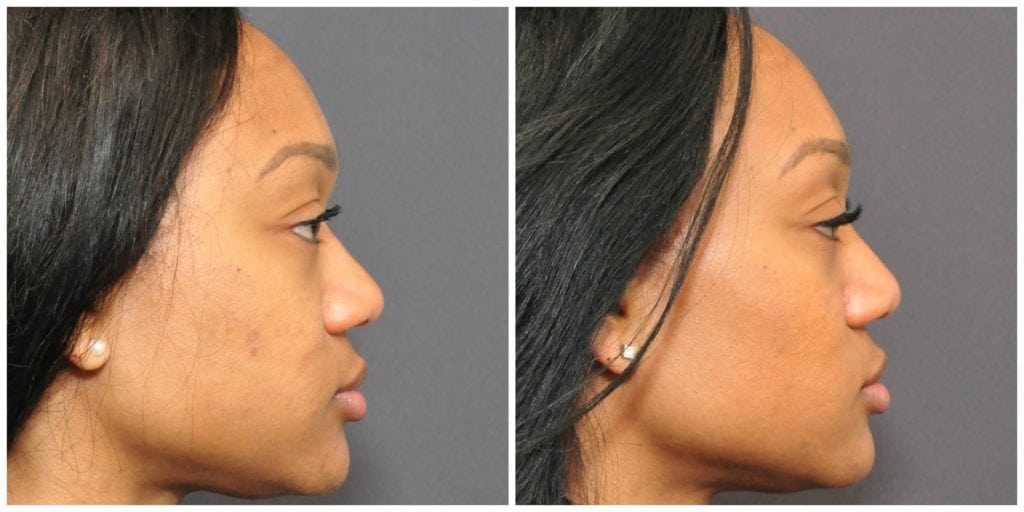 non surgical rhinoplasty before and after san francisco