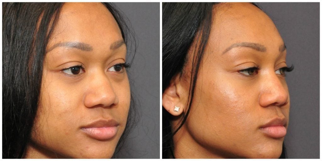 non surgical rhinoplasty before and after san francisco