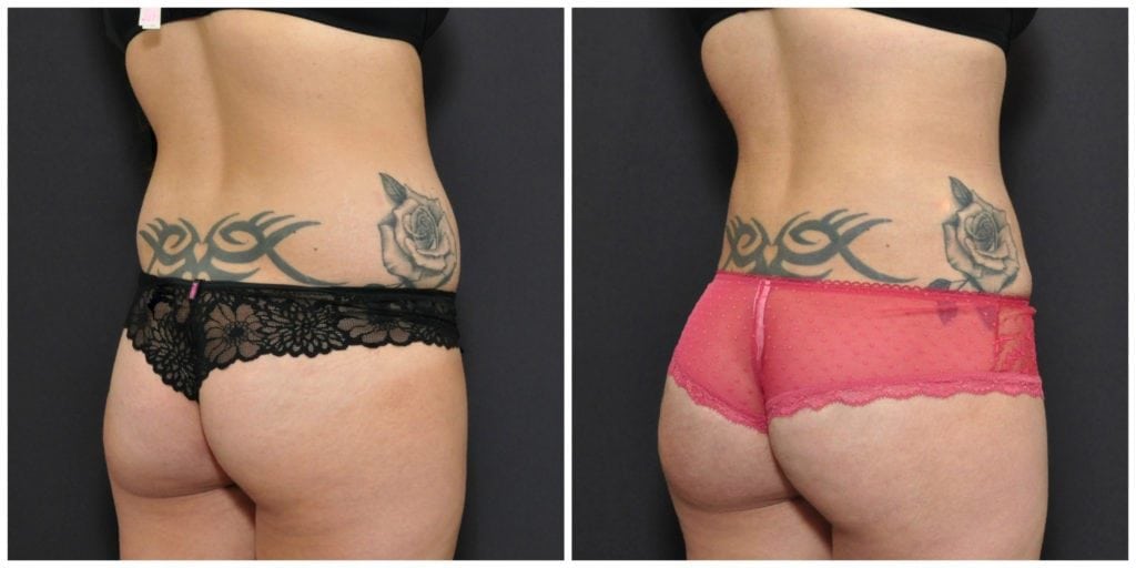 brazilian butt lift san francisco results
