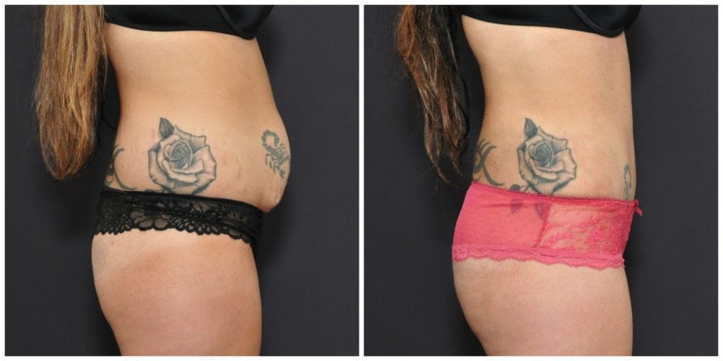 tummy tuck before and after san francisco