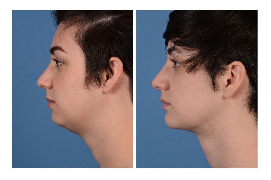 chin implant bay area results