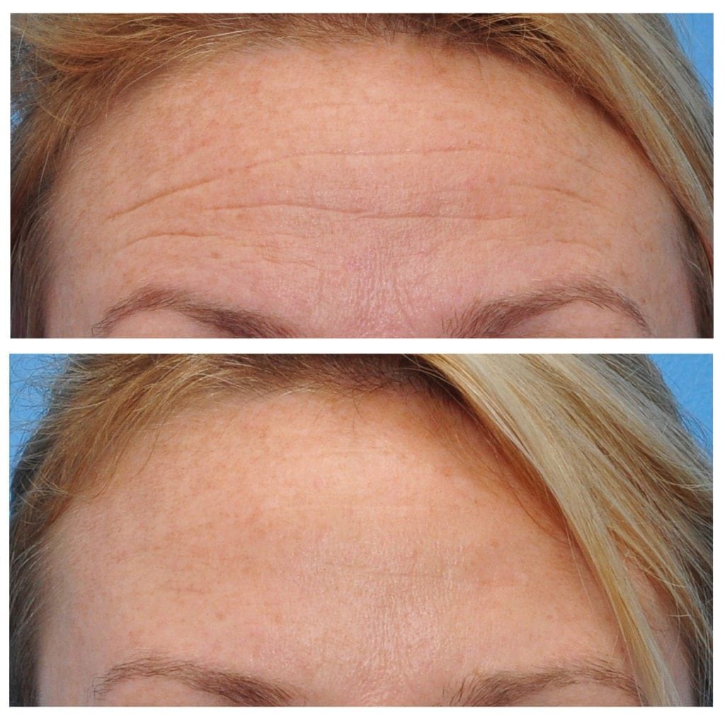 botox results san francisco