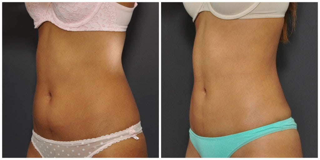 liposuction san francisco before and after