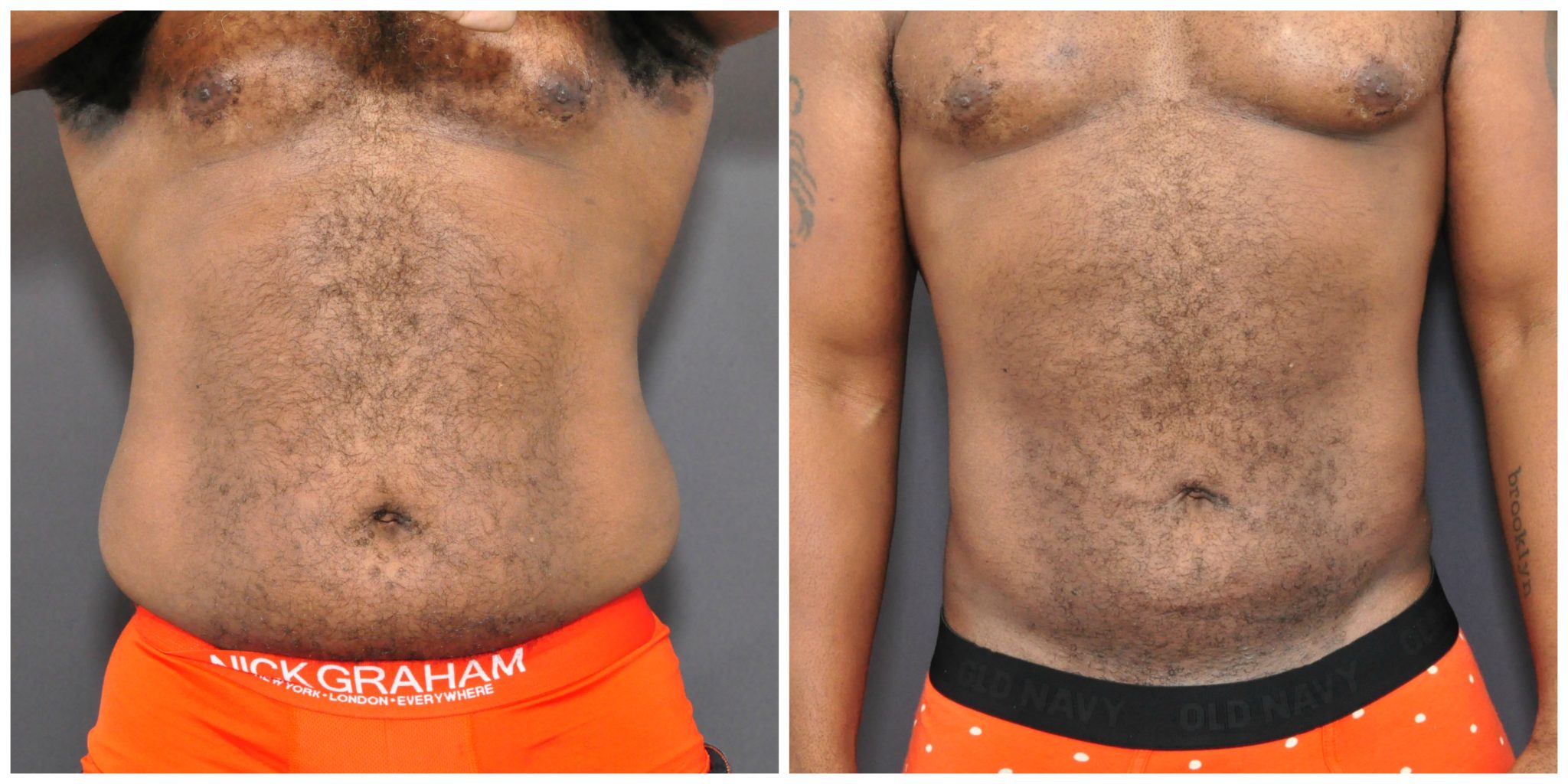 Mens Liposuction San Francisco