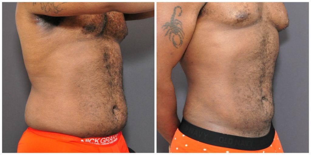 Mens Liposuction San Francisco