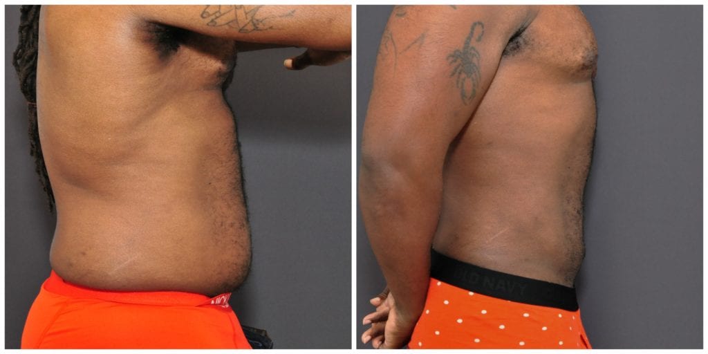 Mens Liposuction San Francisco