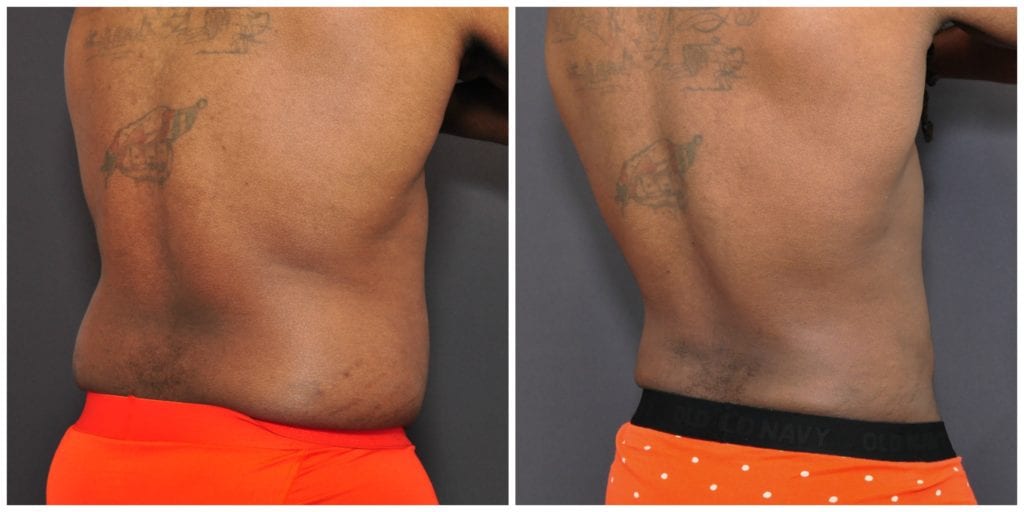 Mens Liposuction San Francisco