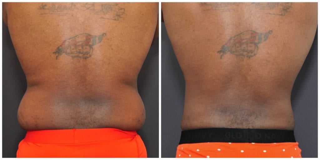 Mens Liposuction San Francisco