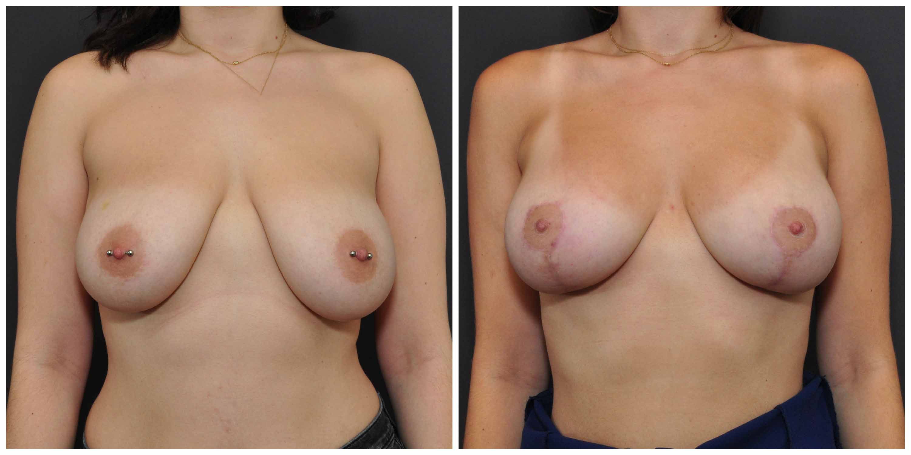 breast augmentation and lift bay area results