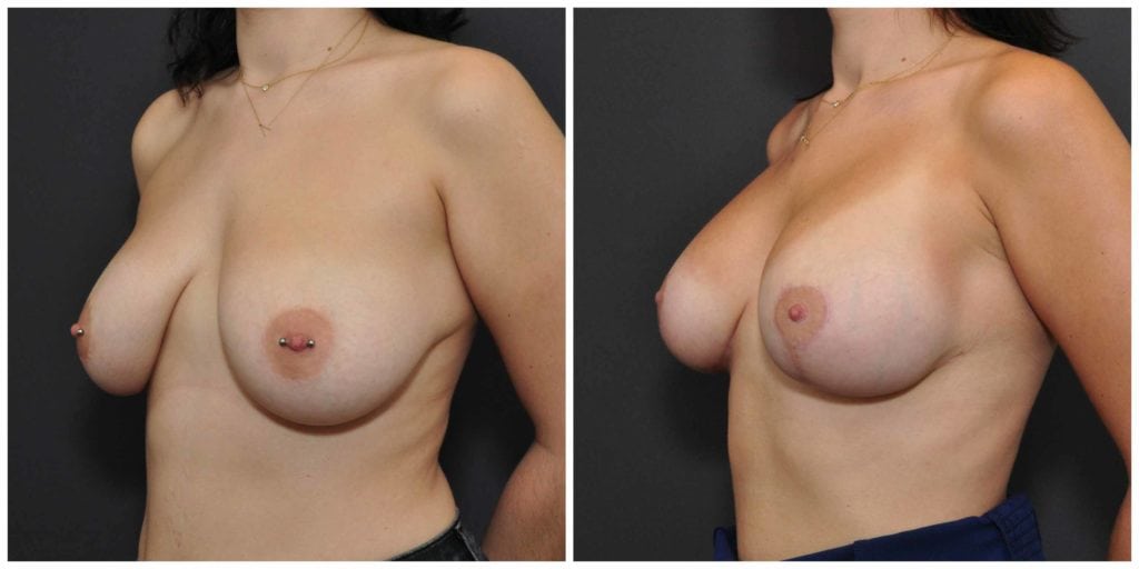 breast augmentation and lift bay area results