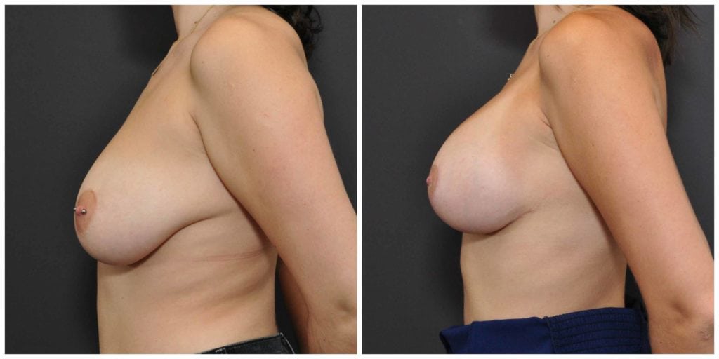 breast augmentation and lift bay area results