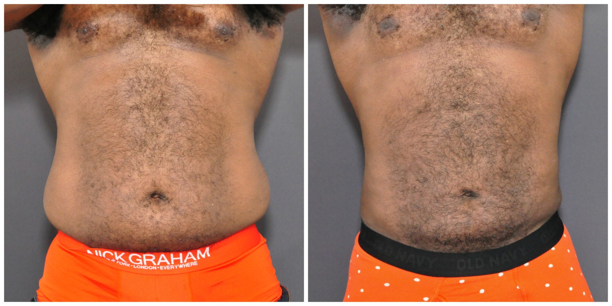 male liposuction before and after san francisco