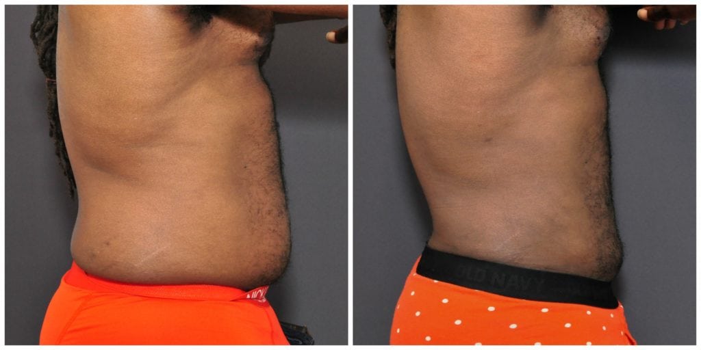 male liposuction before and after san francisco
