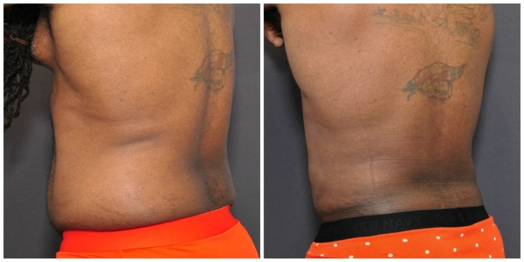 liposuction before and after bay area