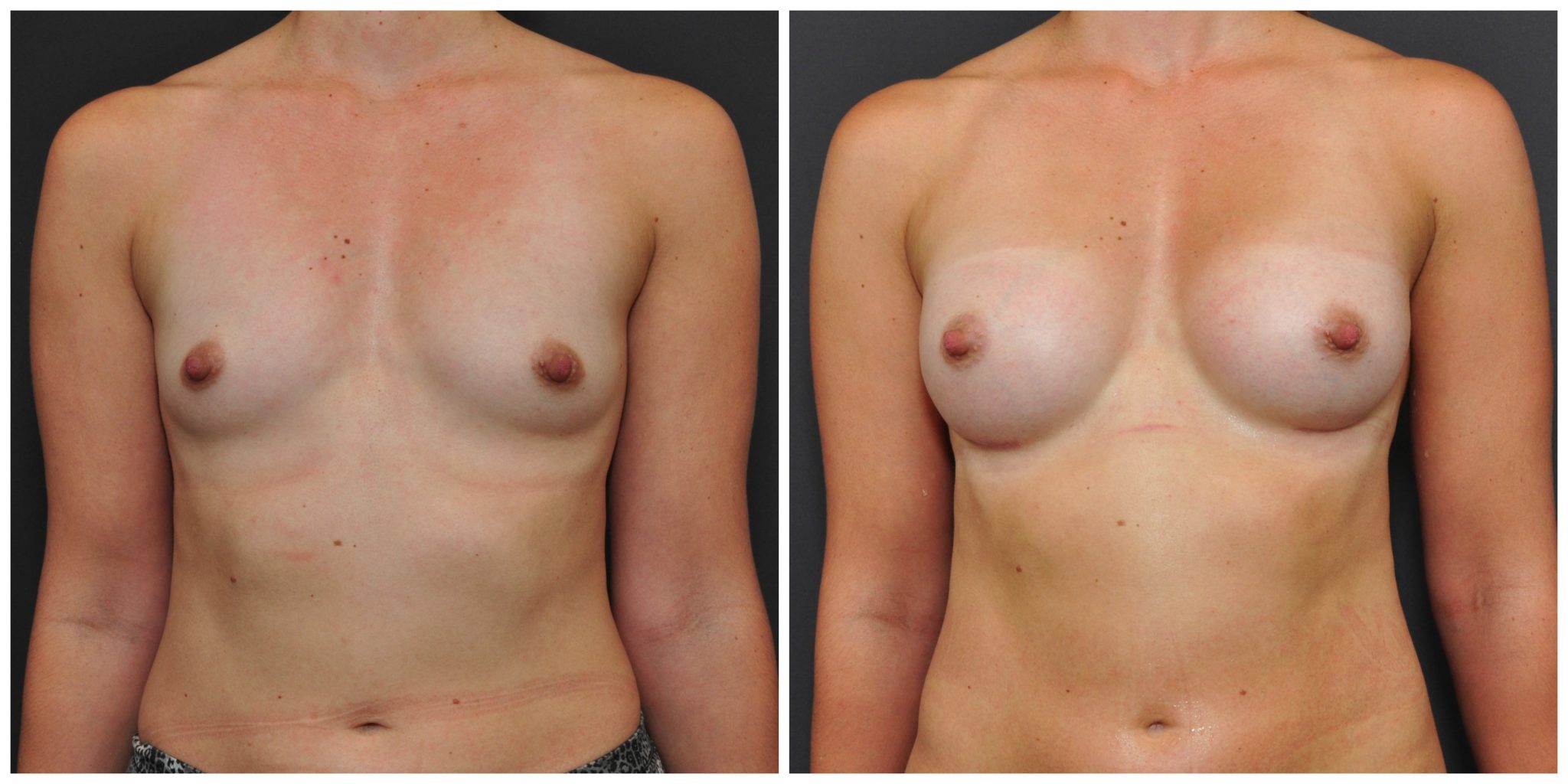 breast augmentation before and after san francisco