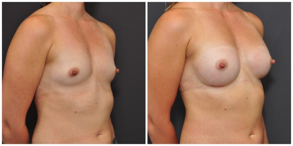 breast augmentation before and after san francisco