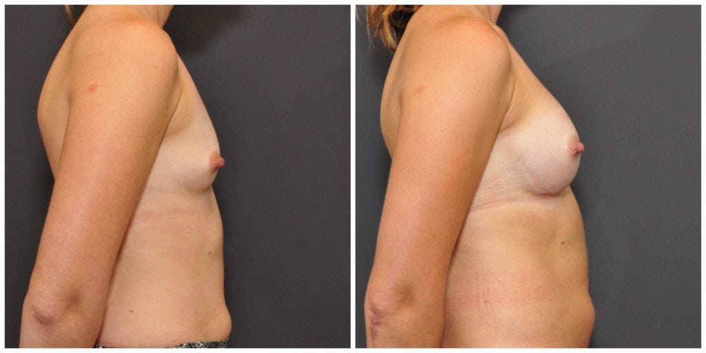 breast augmentation before and after san francisco