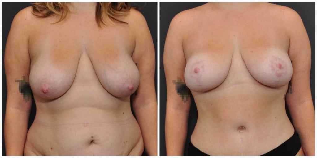 breast lift before and after san francisco